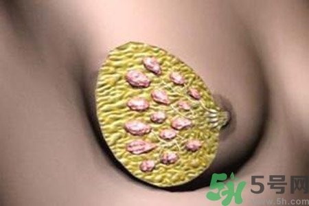 乳腺增生鈣化是什么？乳腺鈣化的癥狀有哪些？