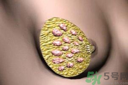 產(chǎn)生乳腺增生鈣化的病因是什么？乳腺增生怎樣治療？