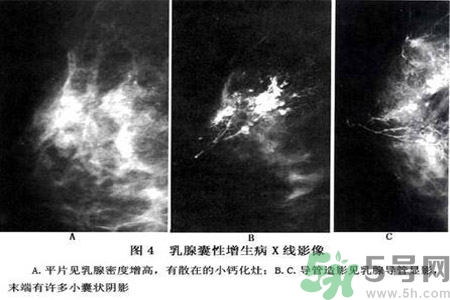 乳腺增生鈣化是什么？乳腺鈣化的癥狀有哪些？