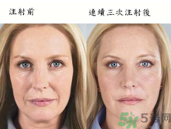 3D液態(tài)拉皮多少錢？3D液態(tài)拉皮后多久見效？