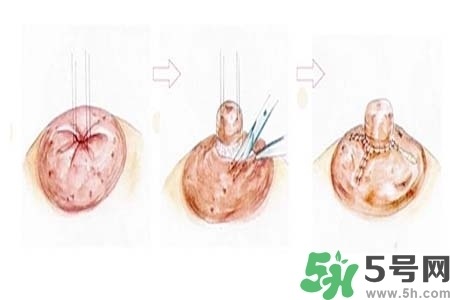 乳頭內(nèi)陷怎么矯正？乳頭內(nèi)陷矯正方法是什么？