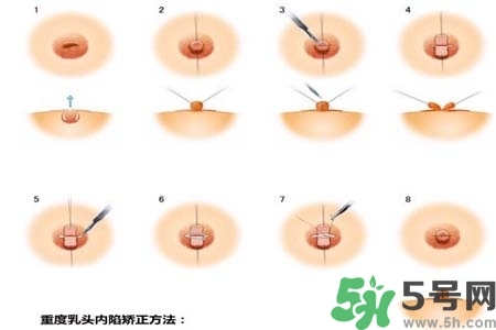 乳頭內(nèi)陷怎么矯正？乳頭內(nèi)陷矯正方法是什么？