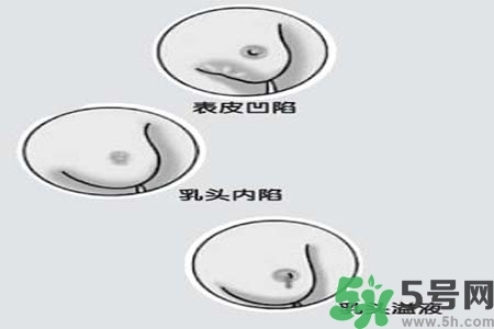 乳頭內(nèi)陷怎么矯正？乳頭內(nèi)陷矯正方法是什么？
