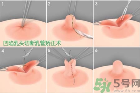 乳頭內(nèi)陷怎么矯正？乳頭內(nèi)陷矯正方法是什么？
