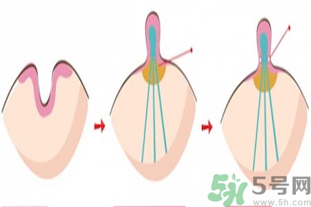 乳頭內(nèi)陷矯正需注意什么？乳頭內(nèi)陷如何預防？