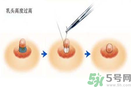 乳頭內(nèi)陷能不能喂奶？乳頭凹陷怎樣哺乳？