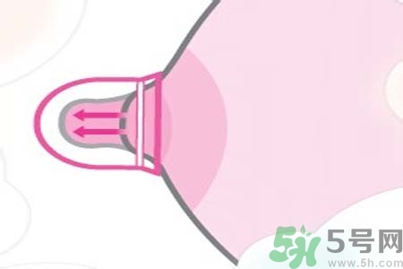 乳頭內(nèi)陷可以拔罐嗎？乳頭內(nèi)陷需要手術(shù)治療嗎？
