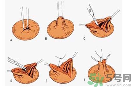 乳頭內(nèi)陷可以拔罐嗎？乳頭內(nèi)陷需要手術(shù)治療嗎？