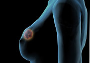 哺乳期乳房有硬塊疼痛怎么辦？如何預(yù)防哺乳期乳房有硬塊？