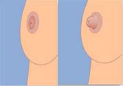 乳頭內(nèi)陷可以用吸奶器嗎？乳頭內(nèi)陷能不能用吸奶器？