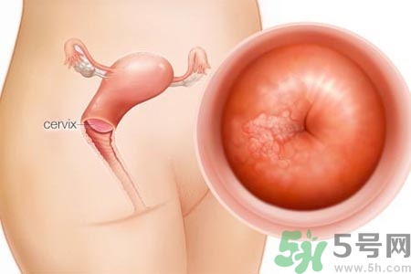 陰道松弛是什么？陰道松弛的癥狀有哪些？