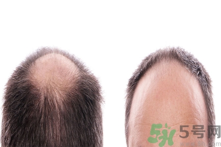 頭發(fā)稀少的原因是什么？如何預(yù)防禿頂?shù)陌l(fā)生？