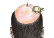 禿頂會遺傳嗎？治療禿頂?shù)姆椒ㄊ鞘裁矗?><p><strong>禿頂會遺傳嗎？治療禿頂?shù)姆椒ㄊ鞘裁矗?/strong></p></a></li> </ul>
</div>
<div   id=