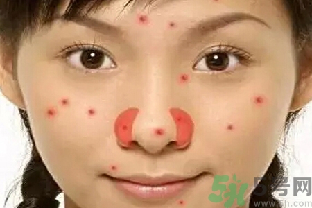 鼻翼長(zhǎng)痘痘怎么回事？鼻翼長(zhǎng)痘痘的原因是什么？