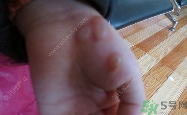 15歲還會(huì)得手足口病嗎？手足口病的癥狀有哪些？
