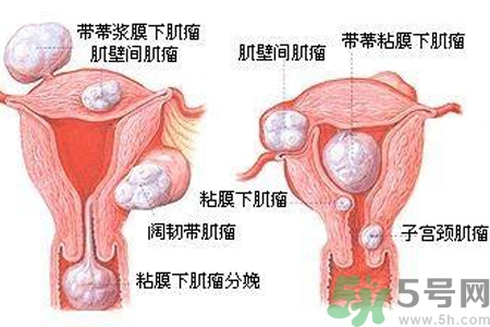 ?子宮移位怎么治療？子宮移位能懷孕嗎？