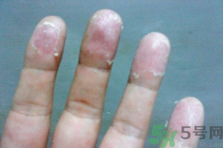 ?手掌脫皮的危害有哪些？如何預(yù)防手掌脫皮？