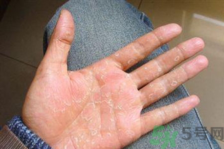 ?手掌脫皮的危害有哪些？如何預(yù)防手掌脫皮？