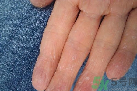 ?手掌脫皮的危害有哪些？如何預(yù)防手掌脫皮？