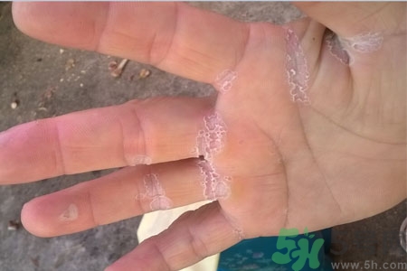 手脫皮是什么原因？手脫皮的治療方法是什么？