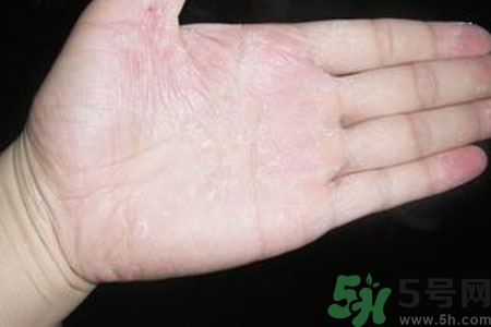 手脫皮是什么原因？手脫皮的治療方法是什么？