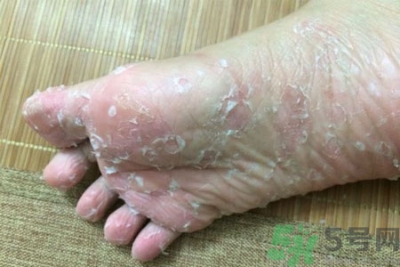 腳脫皮是怎么回事？腳脫皮怎么辦？