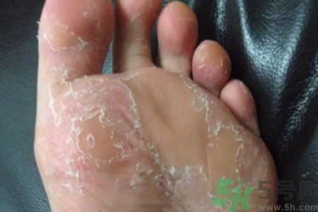 腳脫皮是怎么回事？腳脫皮怎么辦？