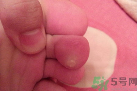 雞眼如何去除？腳上長了雞眼怎么治療？
