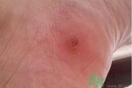 腳上長雞眼是怎么回事？腳上長雞眼是怎么辦？