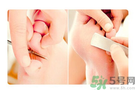 雞眼怎么能徹底根治？如何預(yù)防腳上長(zhǎng)雞眼？