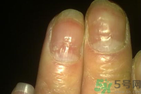 孩子手指甲凹凸不平是什么原因？手指甲凹凸不平的原因是什么？