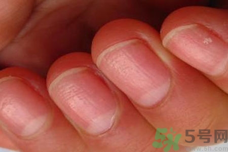 手指甲凹凸不平是怎么回事？如何預(yù)防手指甲凹凸不平？