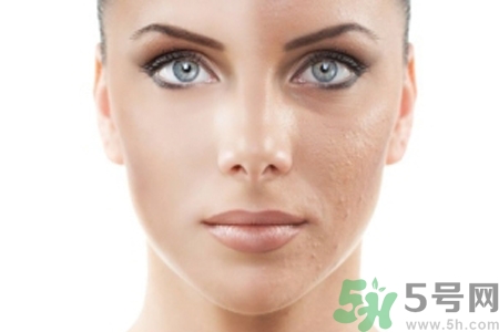 激光縮毛孔多少錢(qián)一次？激光縮毛孔一個(gè)療程多少錢(qián)？