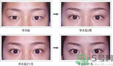 提眉術(shù)后多久可以恢復(fù)？提眉術(shù)后全過程照片