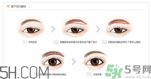 切眉手術(shù)后老得快嗎？切眉能保持多久？