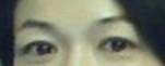 提眉術(shù)后多久可以恢復(fù)？提眉術(shù)后全過程照片