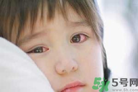 流行性腮腺炎的表現(xiàn)有哪些？?流行性腮腺炎飲食怎么調(diào)理？