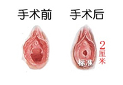 處女膜修補(bǔ)術(shù)效果怎么樣？處女膜修復(fù)手術(shù)有風(fēng)險(xiǎn)嗎？