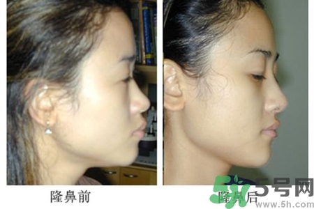 玻尿酸隆鼻的危害有哪些？玻尿酸隆鼻的副作用是什么？