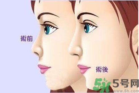 玻尿酸隆鼻的缺點(diǎn)是什么？玻尿酸隆鼻的優(yōu)點(diǎn)有哪些？