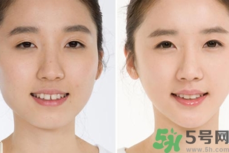 玻尿酸隆鼻的缺點(diǎn)是什么？玻尿酸隆鼻的優(yōu)點(diǎn)有哪些？