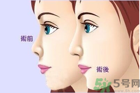 玻尿酸隆鼻和手術(shù)隆鼻的區(qū)別是什么？