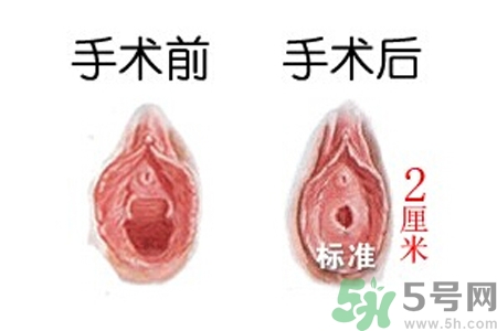 處女膜修補(bǔ)術(shù)效果怎么樣？處女膜修復(fù)手術(shù)有風(fēng)險(xiǎn)嗎？