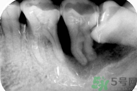 拔智齒一顆多少錢？拔除智齒收費(fèi)多少？