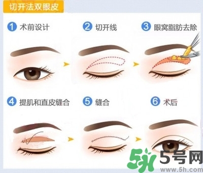 雙眼皮手術(shù)哪種最好？割雙眼皮后注意些什么？