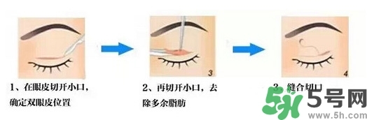 雙眼皮手術(shù)哪種最好？割雙眼皮后注意些什么？