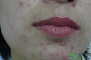 什么樣的痘痘能擠？哪些痘痘不能擠？