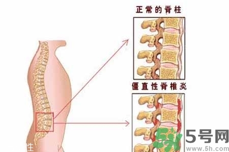 僵直性脊椎炎的癥狀有哪些？怎樣預(yù)防僵直性脊椎炎？