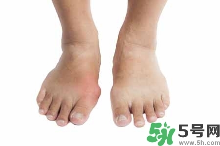 引發(fā)痛風的原因是什么？痛風病人飲食需注意什么好？