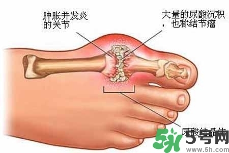 引發(fā)痛風的原因是什么？痛風病人飲食需注意什么好？